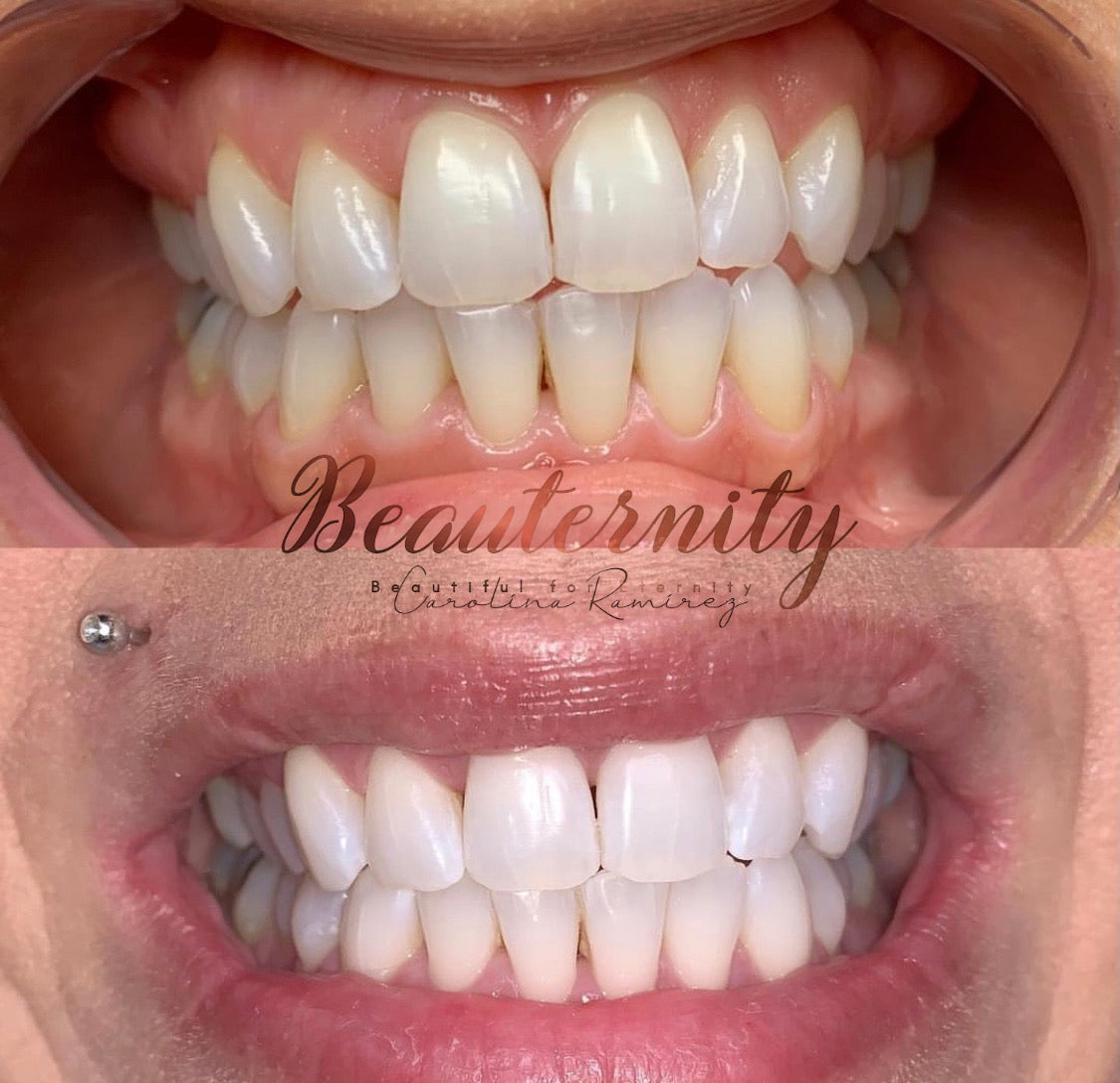 Cosmetic Teeth Whitening