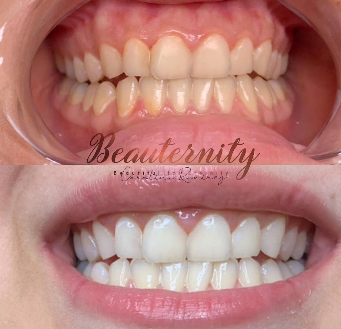 Cosmetic Teeth Whitening
